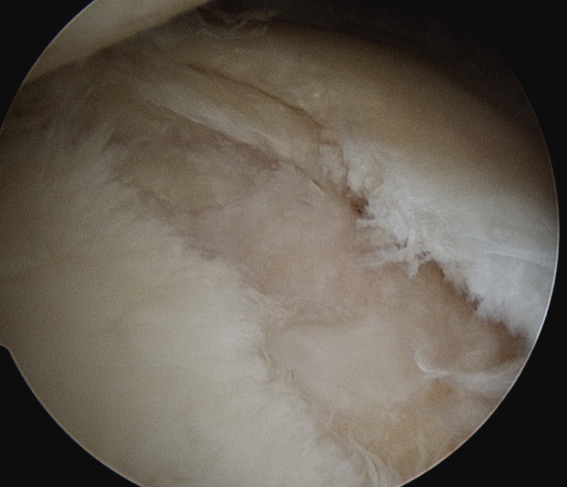 Posterior Labral Tear Cyst 1